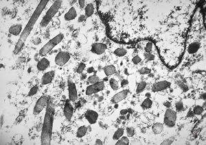 F,39y. | metastatic alveolar sarcoma of soft parts F,39y. | metastatic alveolar sarcoma of soft parts
